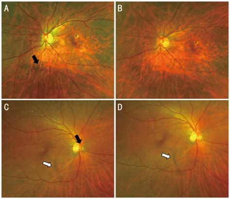 yag laser kilmarnock|Safety and Efficacy of YAG Laser Vitreolysis for the Treatment of.